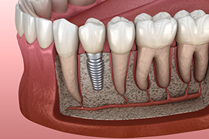 Animation of dental implant placement after bone graft